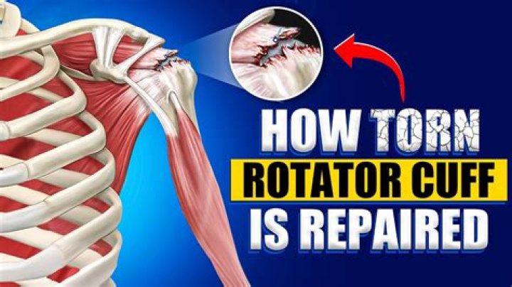Is heat or cold better for torn rotator cuff?
