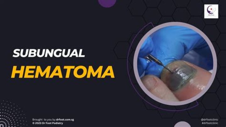 Should I go to the ER for subungual hematoma?