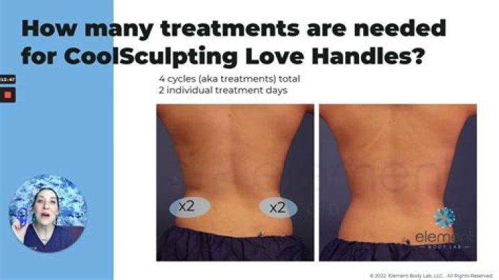 Should I keep massaging after CoolSculpting?
