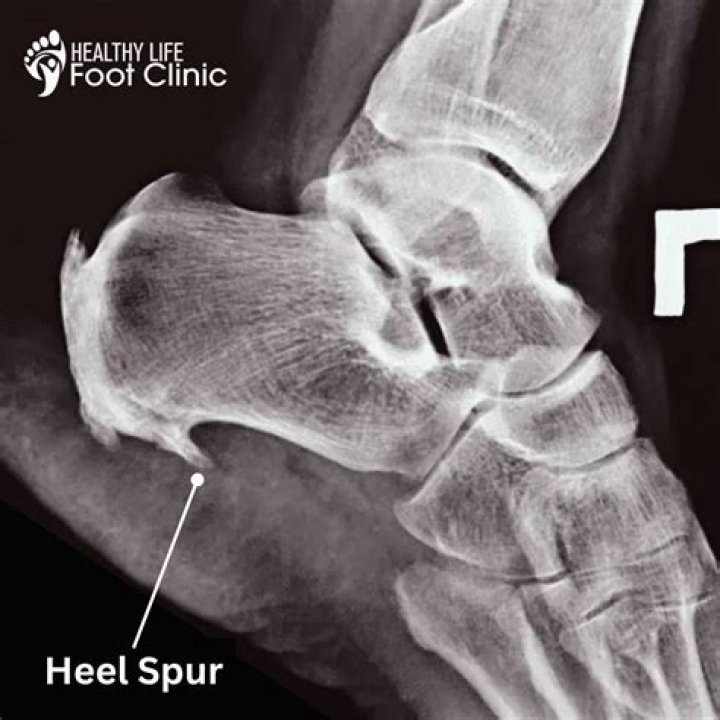 What aggravates a heel spur?