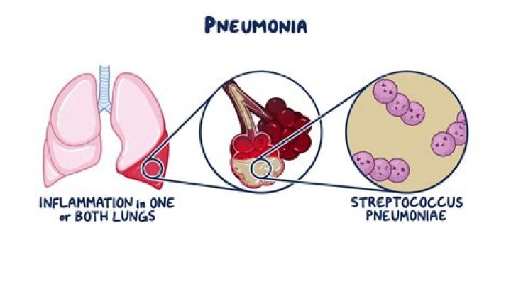 What are the final stages of pneumonia?