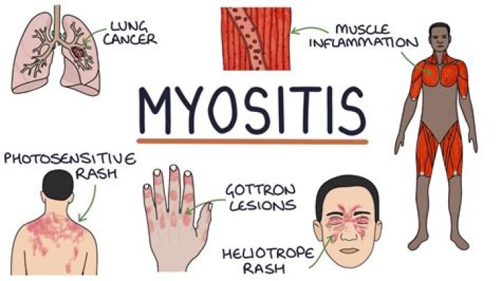 What autoimmune disease causes myositis?