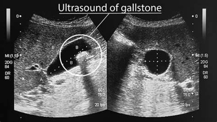 What can ultrasound detect in bladder?
