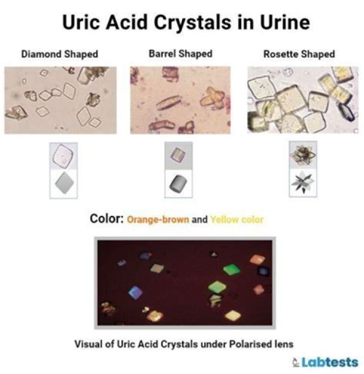 What color is uric acid in urine?
