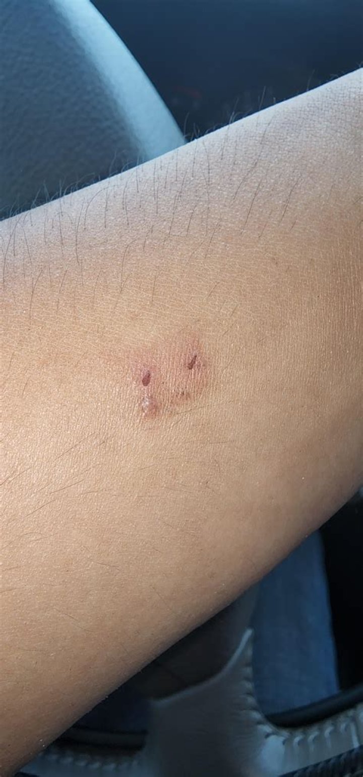 What do bat bites look like on humans?
