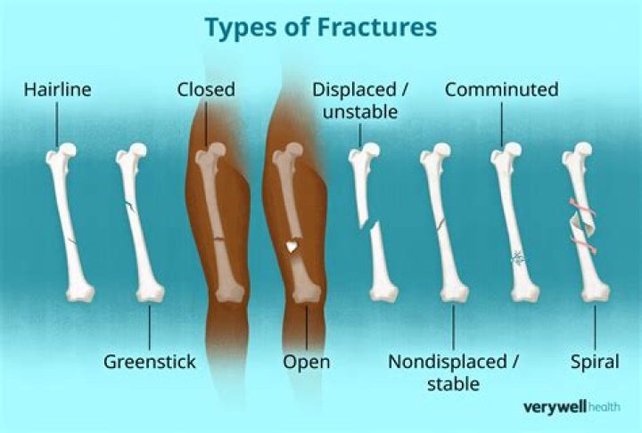 What do you know about fracture?