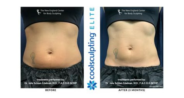 What does CoolSculpting feel like after?