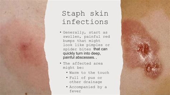 What does staph infection smell like?