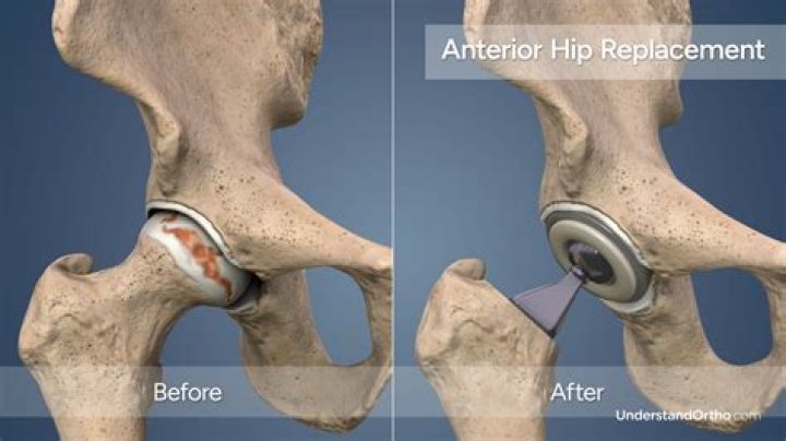 What happens at 4 months after hip replacement?