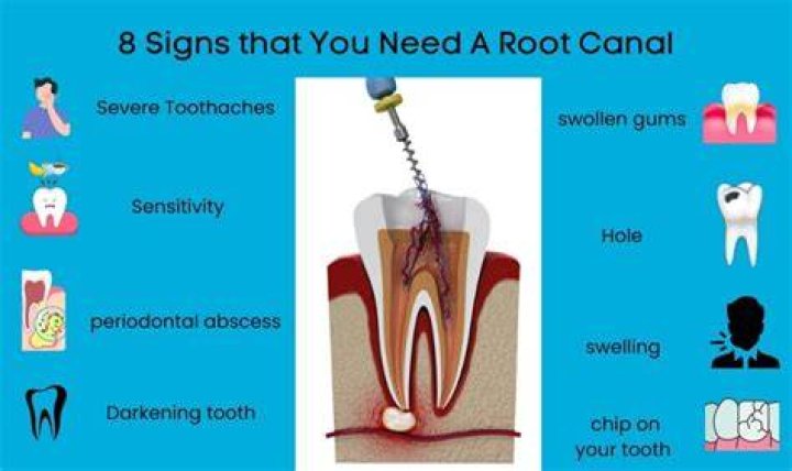 What happens if I need a root canal and don't get it?