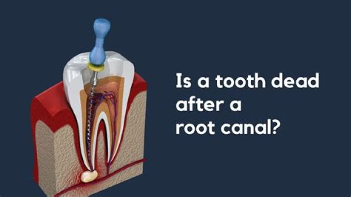 What happens if you leave a tooth that needs root canal?