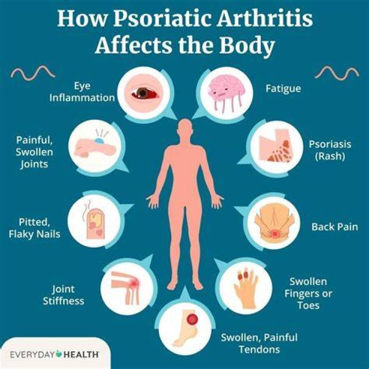 What is the best thing to take for psoriatic arthritis?