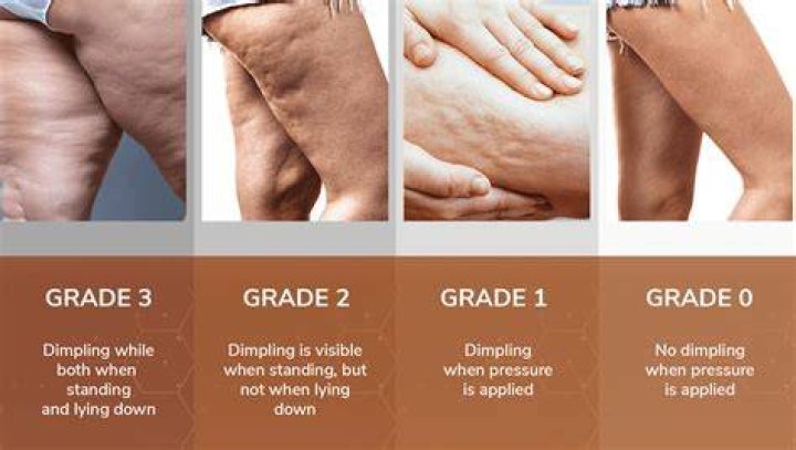 What is the fat on your thighs called?