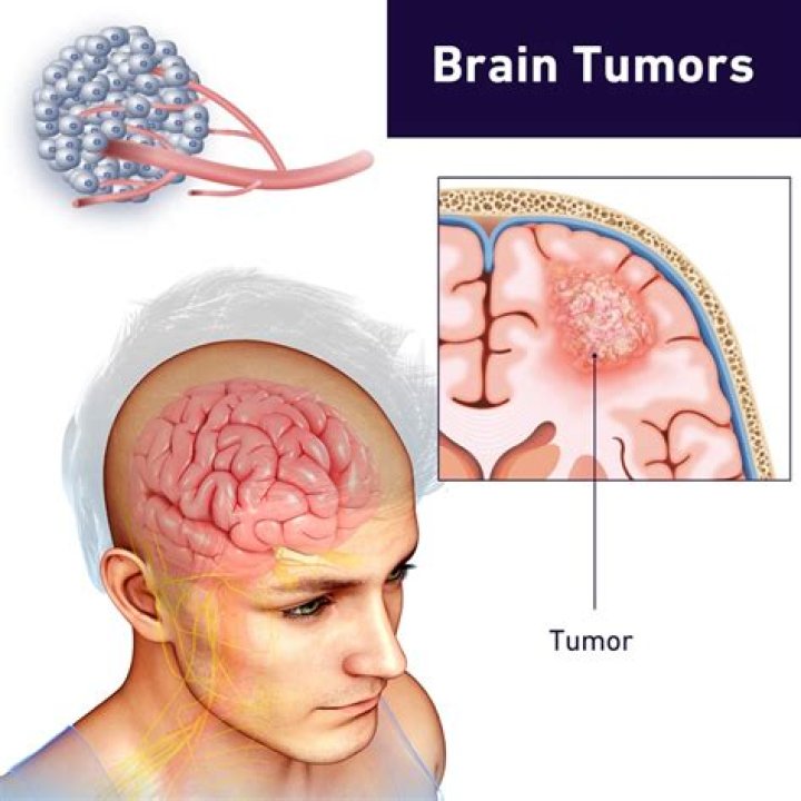What is the main cause of brain tumors?