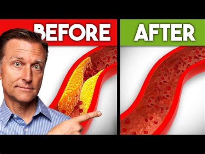 What vitamin removes plaque from arteries?