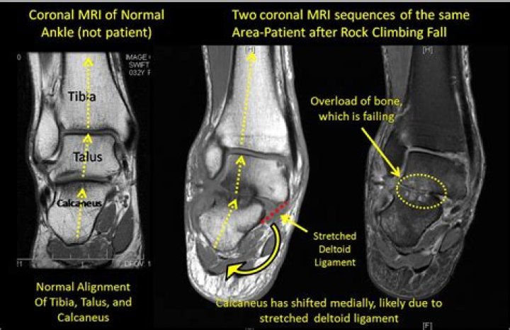 What will an MRI of my ankle show?
