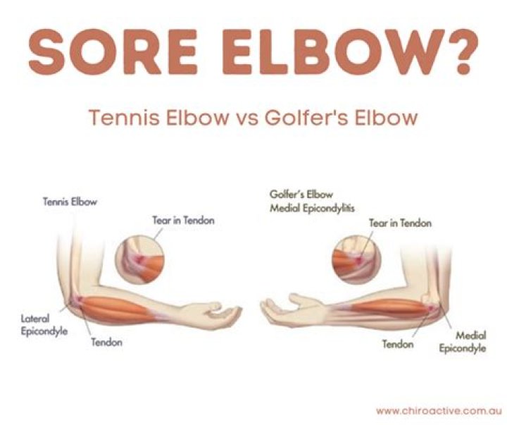 What's the difference between tennis elbow and golfers elbow?