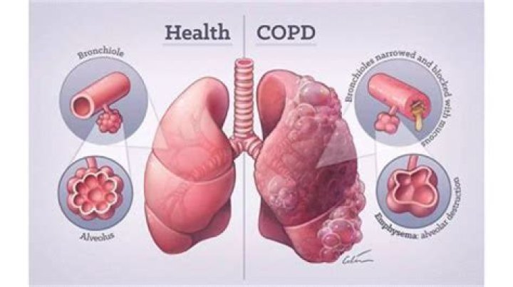 Why do COPD patients get pneumonia?