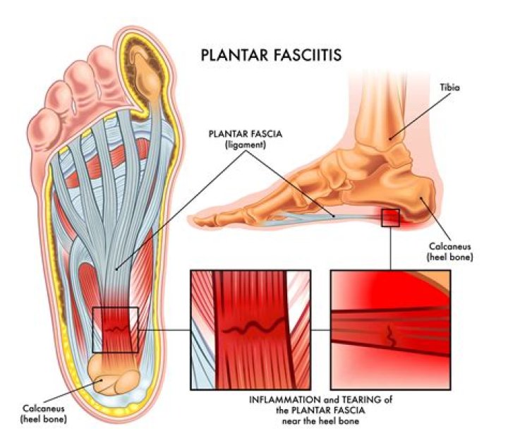 Why does plantar fasciitis get worse at night?