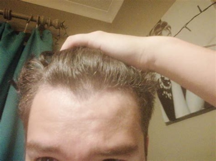 Why is my hair thinning in the front?