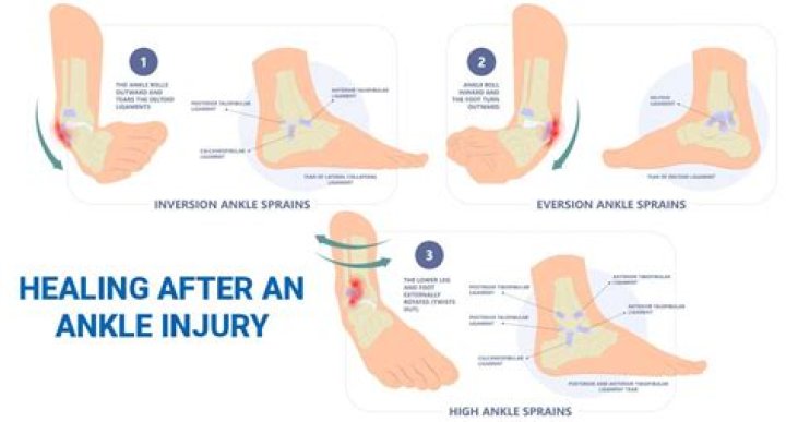 Why is my sprained ankle still swollen after 3 weeks?
