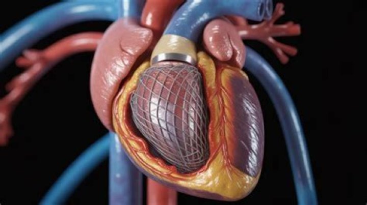 Will I feel better after a stent?