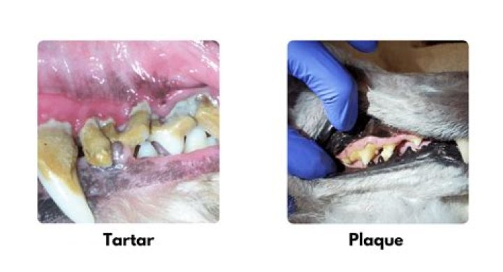 Will Sonicare remove tartar?
