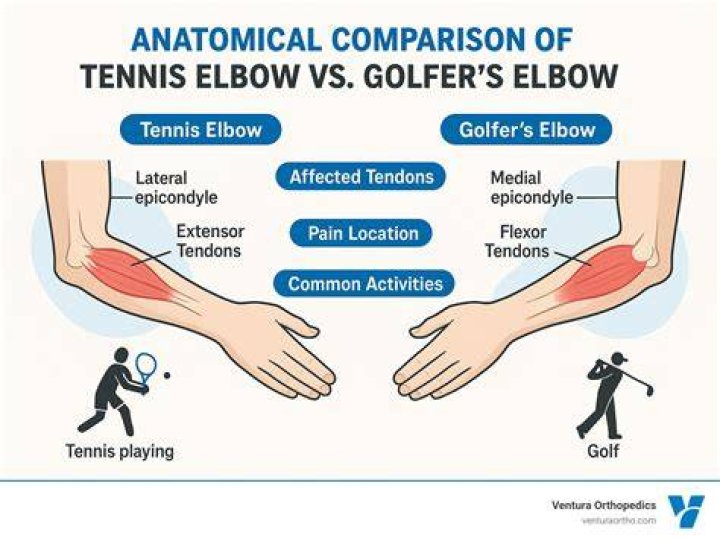 Will tennis elbow ever go away?